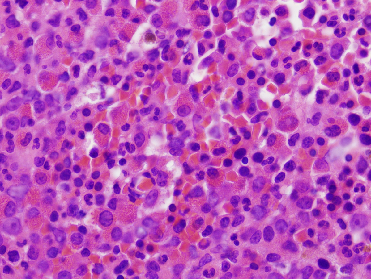 Bone marrow biopsy (BM3) demonstrating eosinophilia and hypercellularity (H&E, 40x).